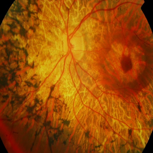Retina Atlas HD